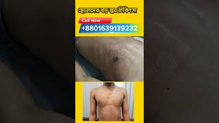 Gynecomastia surgery Bangladesh [upl. by Fanchie]