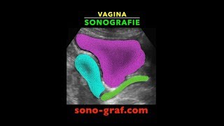 Sonografie  Vagina [upl. by Alleram]