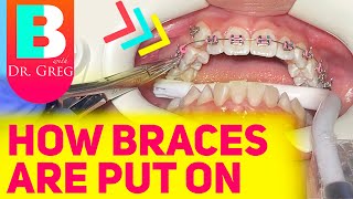 Getting Braces 101  Putting Braces On [upl. by Oca]