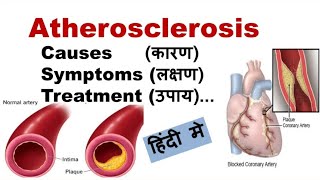 Atherosclerosis  Causes sign and symptoms treatment  Circulatory system disease [upl. by Erlene]