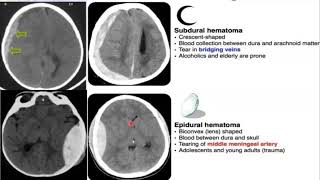 Emergency Neuroradiology Session 1 Spontaneous ICH amp Brain Aneurysms [upl. by Oisinoid]