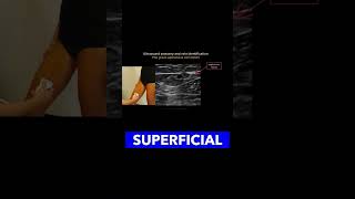 Identifying the Great Saphenous Vein vascularultrasound healthcareexcellence MedicalEducation [upl. by Durante36]