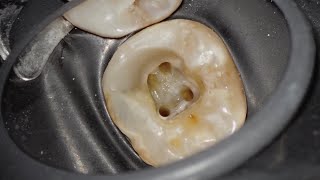 Radix Paramolaris MoustafaEndodontics [upl. by Ahsiekam633]