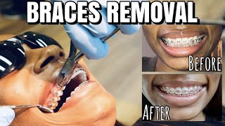 Getting my Braces Removed after 2 Years Very Detailed Process [upl. by Alyad]