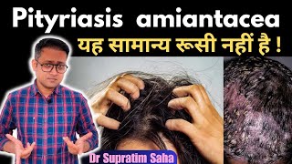 What is pityriasis amiantacea  Treatment  Hindi  Dr Supratim Saha [upl. by Trudi721]