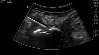 Hip Ultrasound Iliopsoas Bursa Corticosteroid Injection [upl. by Ahsad365]