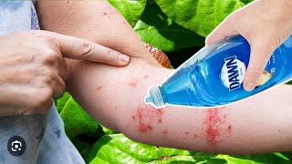 How To Get Rid of POISON IVY With DAWN DISH SOAP Fast DIY Remedy [upl. by Batchelor]