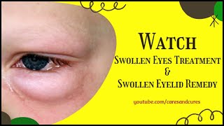 Swollen Eyes Treatment  Puffy Eyelid  How To Treat A Swollen Eye  Swollen Eyelid Remedy [upl. by Manville]