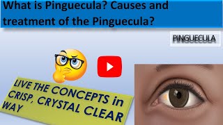 What is Pinguecula  What is the Causes of Pinguecula and the treatment of the Pinguecula [upl. by Froemming748]