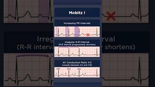 Type I Second Degree Atrioventricular Block ECG AV conduction ratio [upl. by Akeinahs]