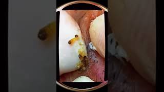 cravos pretos no rosto escreva se no canal para mais vídeos compartilhe acne blackhead [upl. by Shedd]