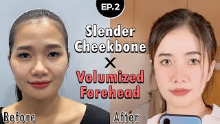 SUB Quick Cheekbone Reduction amp Full Face Fat Grafting Surgery in Korea  Zygoma Reduction RESULTS [upl. by Marlo111]