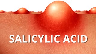 Heres WHY Salicylic Acid is Best For ACNE [upl. by Yenahc]