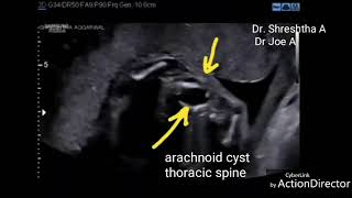 Spinal arachnoid cyst fetus ultrasound video [upl. by Aitrop679]