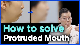 EN Protruded Mouth How to solve Protruded Mouth l Korean lantern jaw surgery case review [upl. by Seira292]