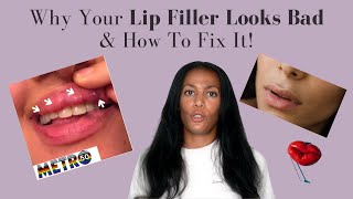 What Makes Lip Filler Look Bad  How To Fix Lip Filler Problems  Top Lip Filler Tips [upl. by Ailito629]