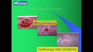 MAIKONG Diabetic Foot Capillaries Therapy SystemPDN [upl. by Sollie]