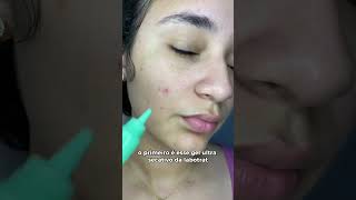 Gel ultra secativo de espinhas Labotrat  indique um na legenda skincare rosto cuidadosfaciais [upl. by Haon142]