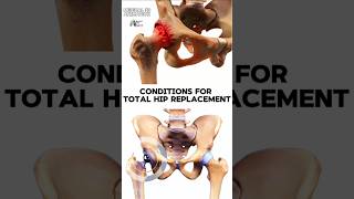 Conditions for Total Hip Replacement medical animation 3d short Biology with Aliya [upl. by Akins]