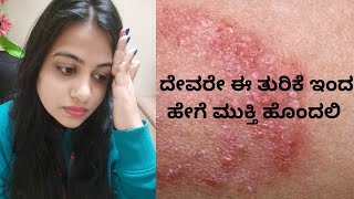 Fungal Infection ಆಗಿದ್ರೆ ಈ ವಿಡಿಯೋ ನೋಡಿ ಗಜಕರ್ಣ ಹುಳುಕಡ್ಡಿ ಗೆ ಪರಿಹಾರ [upl. by Amehsat]