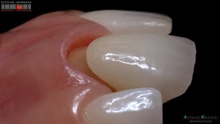 BOPT layered zirconia full crown by cdt Arturo Navoni Intra Oral Scanner Trios 3 by 3Shape [upl. by Naitsihc]