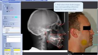 Making superimposition of analysis and photo in Planmeca Romexis® Cephalometric Analysis module [upl. by Hawk872]