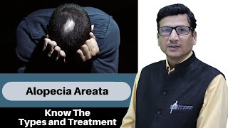 What is Alopecia areata  Causes Diagnosis amp Treatments  Alopecia Areata के बारे में जानकारी [upl. by Bard]