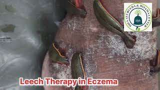 Leech Therapy in Eczema at Difa Ayurveda and Hijama Center Agra [upl. by Tychon]