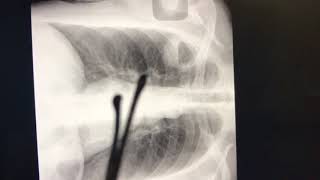 Xray Lung Abcess❤️ Pulmonary TB💜Miliary TB 🧡 [upl. by Eiba993]