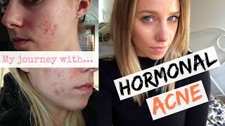 Hormonal Acne  The Pill Curing My Hormonal Acne Naturally [upl. by Younger]