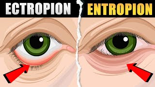 Ectropion and Entropion  Causes Symptoms Types and Treatment  Ectropion vs Entropion [upl. by Gnaoh]