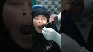 Composite Filling  Cavity in Tooth  How to fillplease Channel ko Subseribe kre [upl. by Morra]