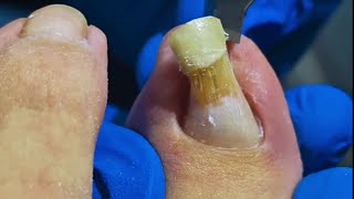 Podiatrist Reveals Simple Trick to Trim Long Thick Toenail [upl. by Kovacs566]