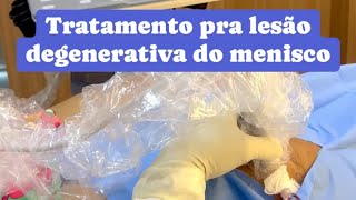 Tratamento pra lesão degenerativa do menisco no joelho [upl. by Sinnard]