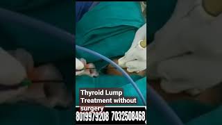 Live Thyroid Nodule Ablation Procedure Video thyroid thyroidablation shorts trending viral [upl. by Omsare]