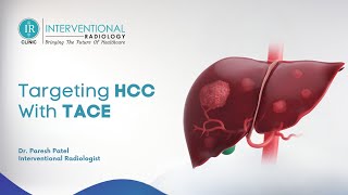 HCC Liver Cancer Understanding Treatment and TACE in English [upl. by Sessler608]