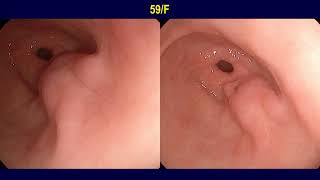 A common cause of gastric submucosal lesion and small bowel obstruction [upl. by Alric]