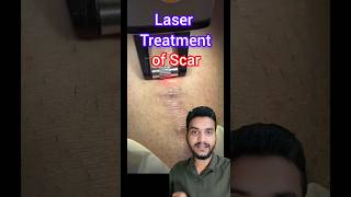 Laser treatment Keloid scar shorts [upl. by Melissa]