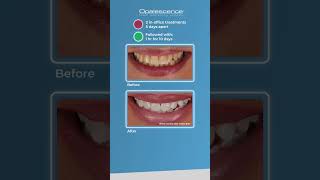 Opalescence™ Boost™ and Opalescence Go™  Case Study [upl. by Idieh]