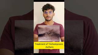 Treatment of Trichomycosis Axillaris dermatology skincaretips shorts skininfection ytshorts [upl. by Vidovic]