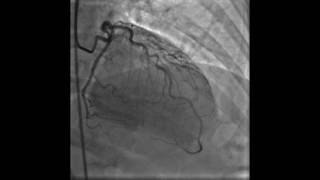 Coronary Angiogram of Myocardial Bridging [upl. by Yrreiht]