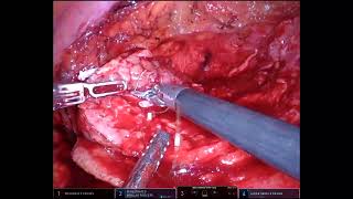 Robotic Nephron Sparing Surgery for Large Endophytic Renal Mass [upl. by Grant115]