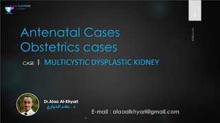 Multicystic dysplastic kidney [upl. by Ilak]