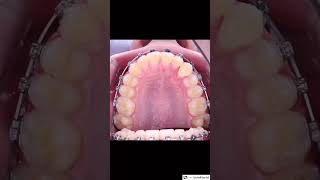 Braces Before and after  timelapse  your dentist shots shortvideo shorts [upl. by Adnole]