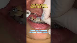 Close the diastema between front teeth by Braces [upl. by Des1]