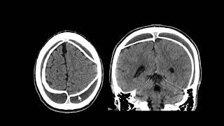 Hematoma subdural crônico calcificado [upl. by Checani]