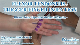 FLEXOR TENDONITIS  TRIGGER FINGER INJECTION  Simulation Series [upl. by Ceevah]