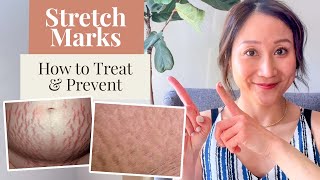 Can You Prevent Stretch Marks A Dermatologist Explains Causes amp Treatments  Dr Sam Ellis [upl. by Linda]