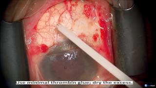 Primary Pterygium Surgery with AmnioGraft Neel Desai MD [upl. by Immaj916]