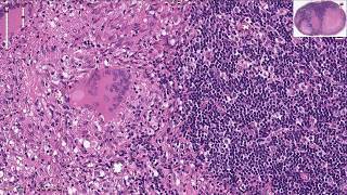 Tuberculosis of the Lymph Node  Histopathology [upl. by Pollyanna]